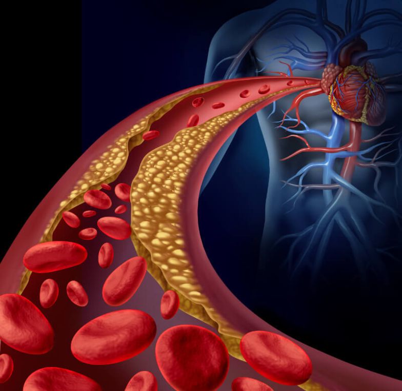 Čo pomáha a ako liečiť aterosklerózu? Tu sú overené možnosti, byliny aj dostupné lieky