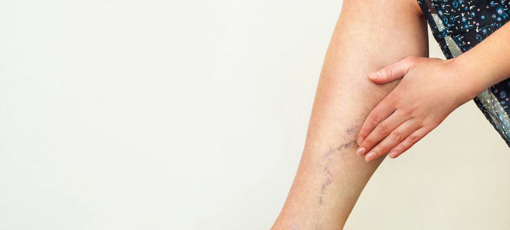 Bolestivé žily môžu byť na nohách aj rukách, aké majú príznaky a čo na ne platí