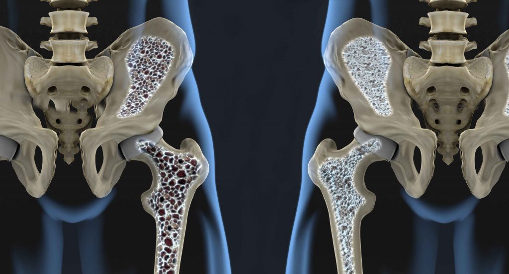 Prevencia osteoporózy nie je len o vápniku. Tu je 7 rád, ako jej najlepšie predchádzať